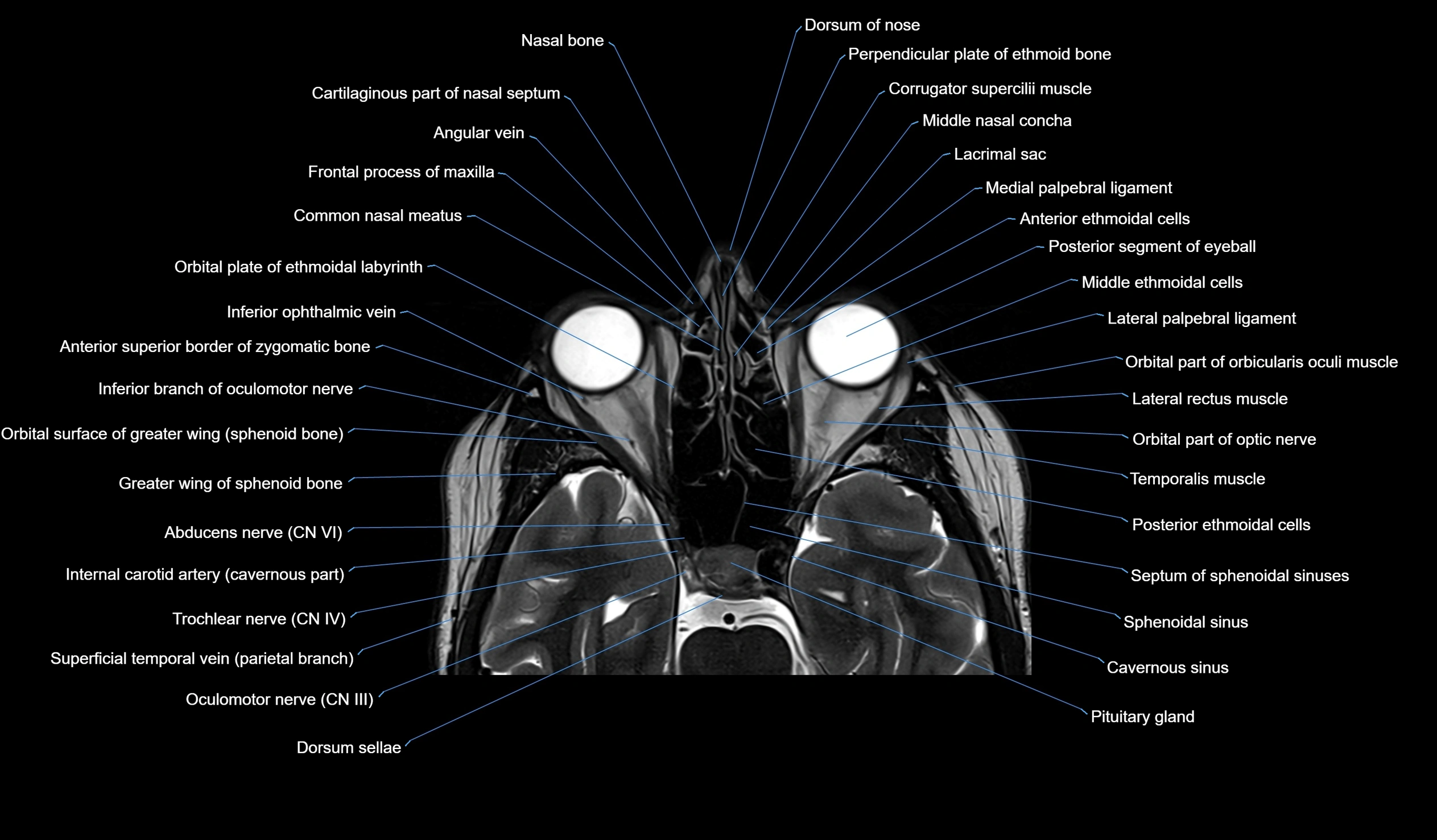 MRI face & paranasal sinuses(PNS) labelled  coronal  cross sectional anatomy 3T radiology  image-img-00001-00020.webp